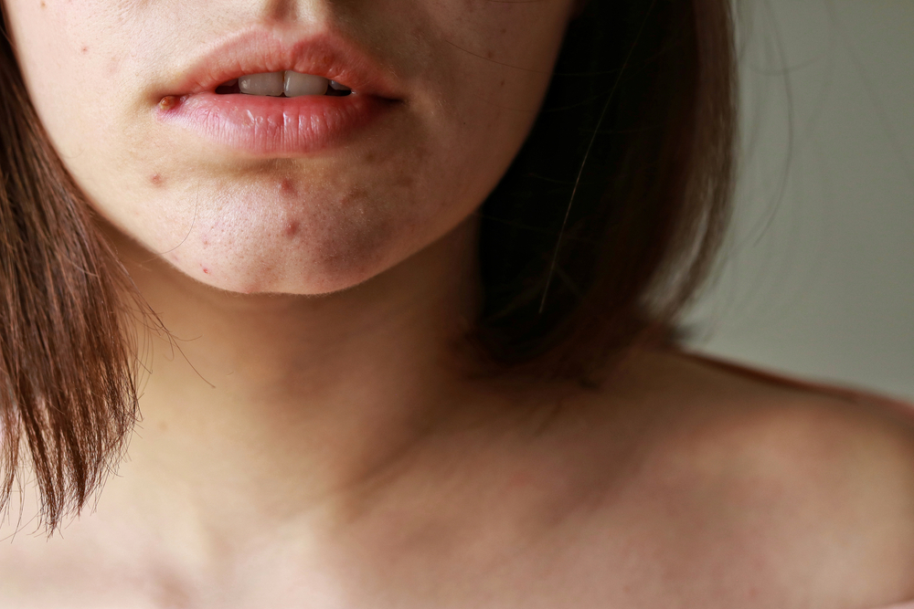 soigner peau acné