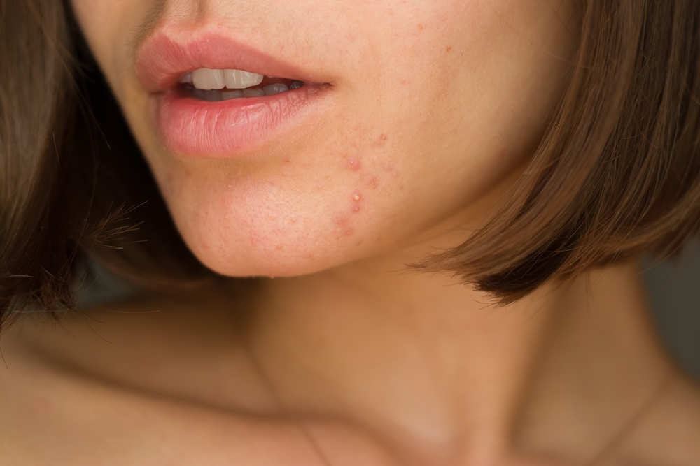 Routine beauté anti acné mode d'emploi