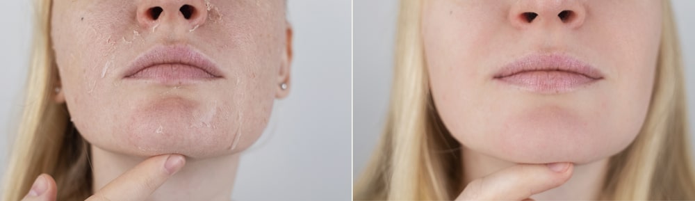 Face peeling before after