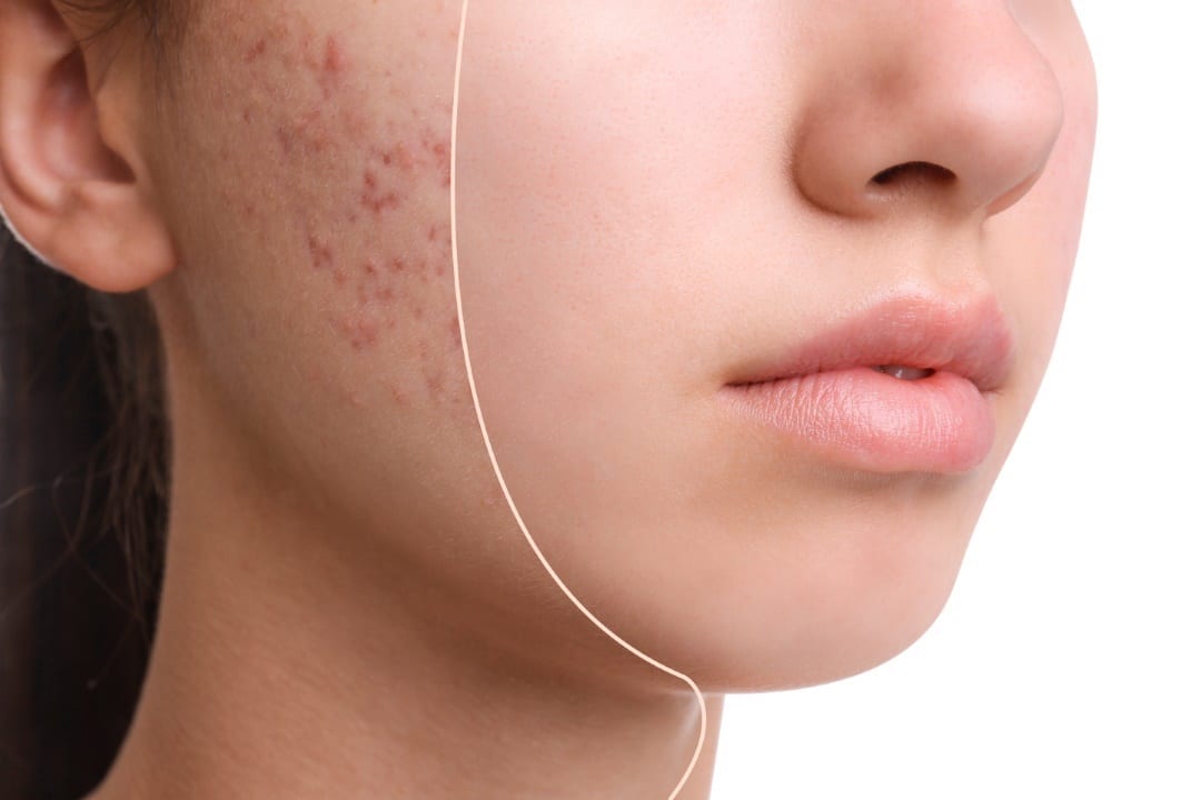 comment atténuer cicatrices acné